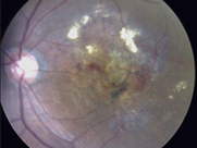 Macular Degeneration Retina Research Hawaii