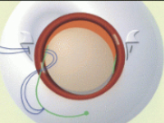 Cataract Surgery Hawaii | Retina Research