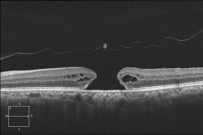 Macular Hole Pre–27 Gauge Surgery - Retina Consultants of Hawaii