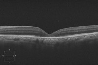 successful closure of macular hole after surgery - Retina Consultants of Hawaii